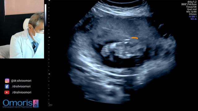 Ultrassom Morfológico - Gestação 23 semanas смотреть онлайн