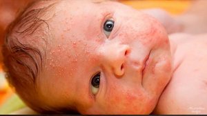 Виды сыпи у детей