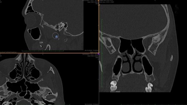 КРЫЛОНЕБНАЯ ЯМКА АНАТОМИЯ ЧАСТЬ 2