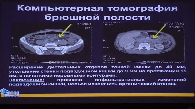 31 Тихомирова ЕВ Язвенный стенозирующий энтерит
