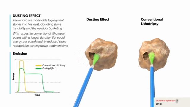 Дастинг-эффект в литотрипсии смотреть онлайн
