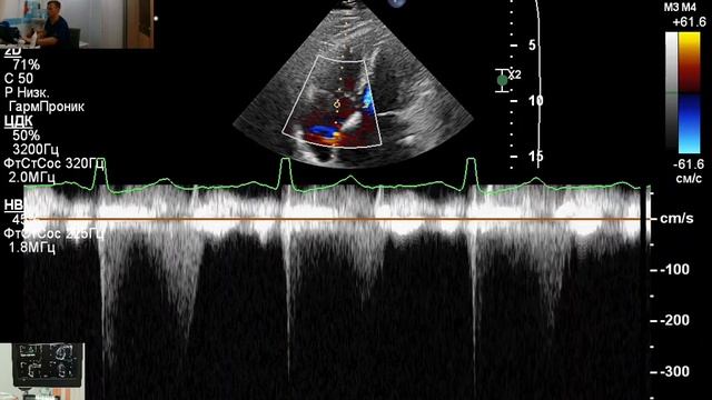 ЭХОКГ в Уссурийске: порок сердца: митральный стеноз смотреть онлайн