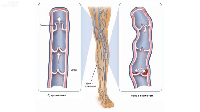 Она ИЗБАВИЛАСЬ от ВАРИКОЗНОГО РАСШИРЕНИЯ ВЕН с помощью ПРОСТОГО РЕЦЕПТА смотреть онлайн