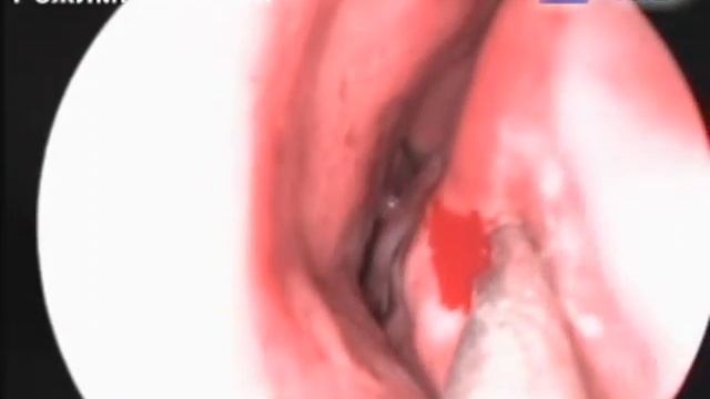 Деструкция локальной гипертрофии нижней носовой раковины смотреть онлайн