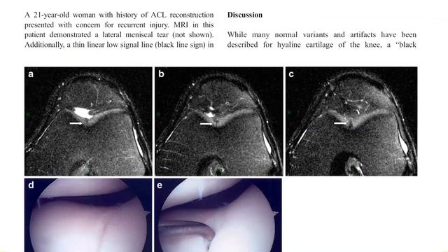 The Black Line Sign On Knee MRI