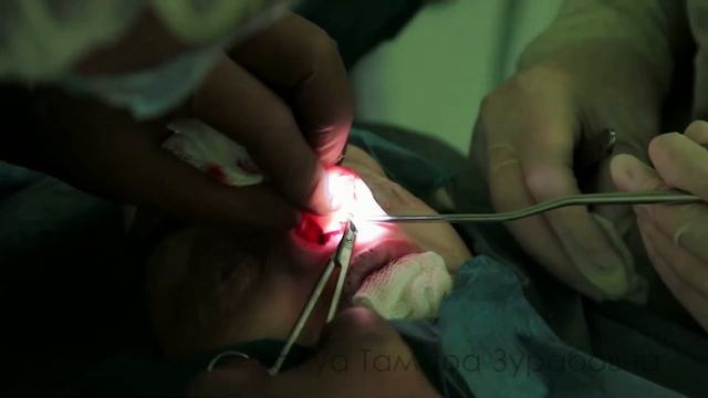 Чкадуа Т.З. Расщелина, хейлопластика, липофилинг, ринопластика смотреть онлайн