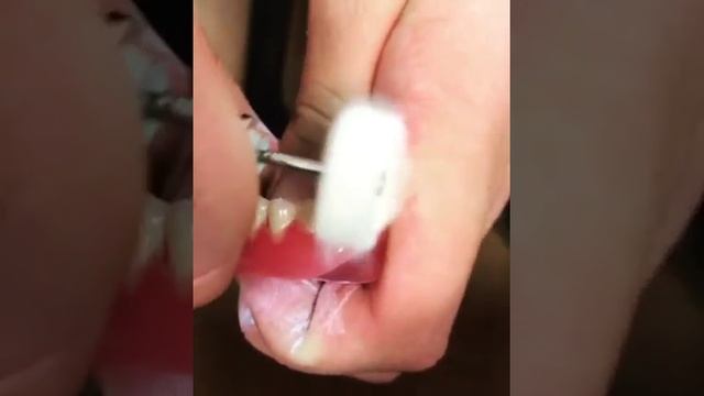 Полировка съемного протеза! смотреть онлайн