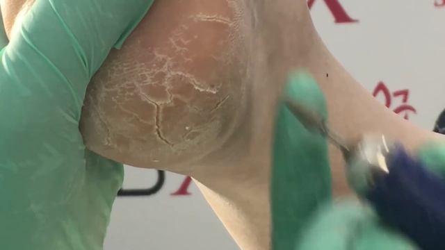 Мастер-класс DoctorDerm: аппаратная обработка глубоких трещин на пятках смотреть онлайн