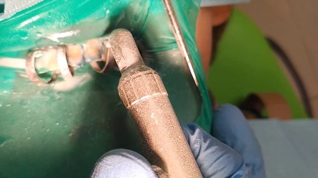 Абразивная обработка поверхности зуба 22,23. Оксидом алюминия 30 мкм. смотреть онлайн