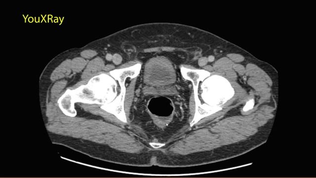 Рак прямой кишки на КТ смотреть онлайн
