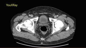 Рак прямой кишки на КТ