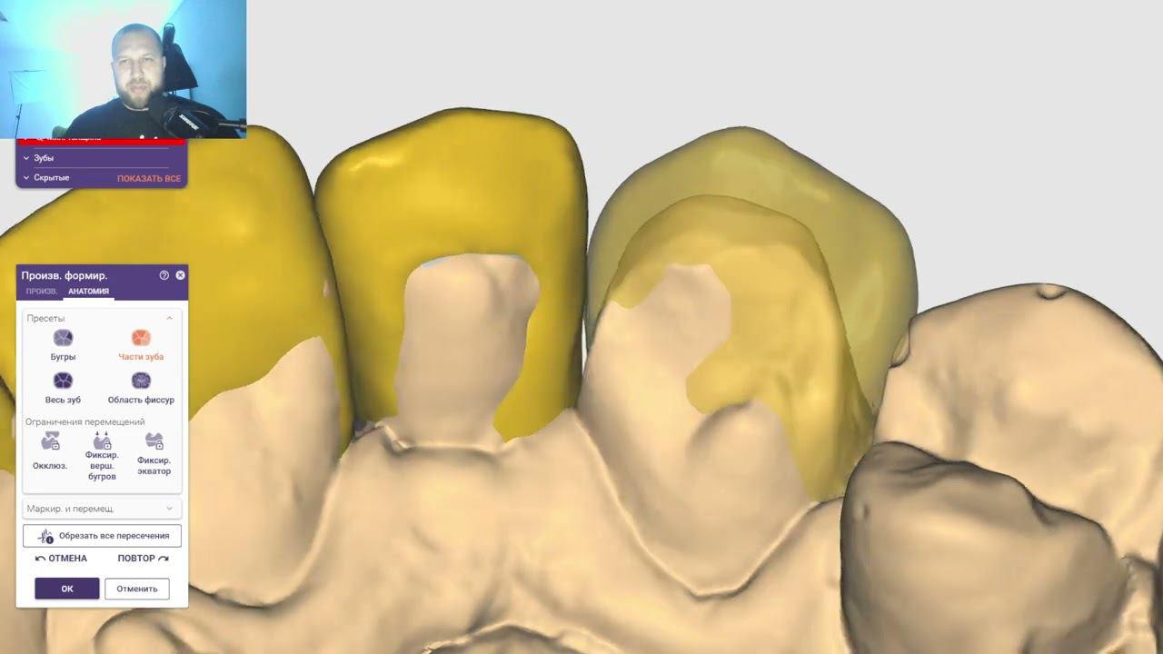 Разбор работы планирование как сделать виниры, если кривые зубы? Разбор работы exocad смотреть онлайн