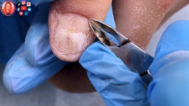 Расковыряла палец / Бугры и ямы на ногтях смотреть онлайн