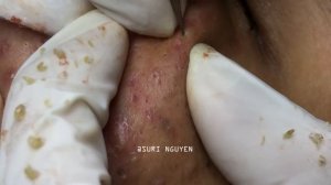 Full Video [1hour 46s]: AMAZING INFLAMED BLACKHEADS POPPING