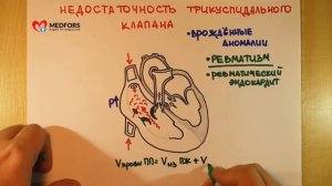 Недостаточность трёхстворчатого клапана   Просто о сложном