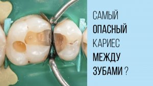 Как лечить кариес между зубами❓