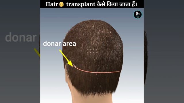 अब कोई व्यक्ति?? गंजा नहीं रहेगा। How is hair transplant done । #Shorts #Scientificshorts смотреть онлайн