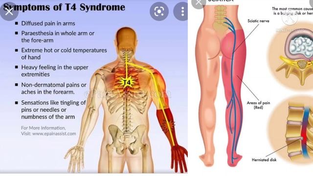 spinal cord injury treatment | spinal injury symptoms | spinal injury treatment | in hindi смотреть онлайн