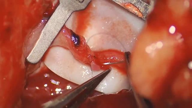 Vascularised lymph node transfer with LVA for lymphedema management смотреть онлайн