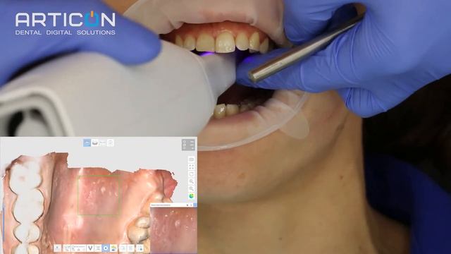 СКАНИРУЙТЕ ВМЕСТЕ С АРТИКОН И МЕДИТ! | ЛАЙФХАКИ ПРИ СКАНИРОВАНИИ | СКАНЕР MEDIT I 500