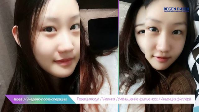 [Regen Story] Красивые контуры с любого угла - Резекция скул смотреть онлайн
