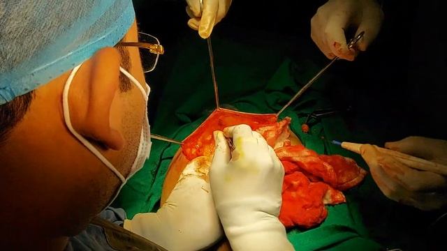 Breast conservation Surgery..Harmonic scalpel ..Live from OT by Dr.Saurabh Dixit at Highland Care смотреть онлайн