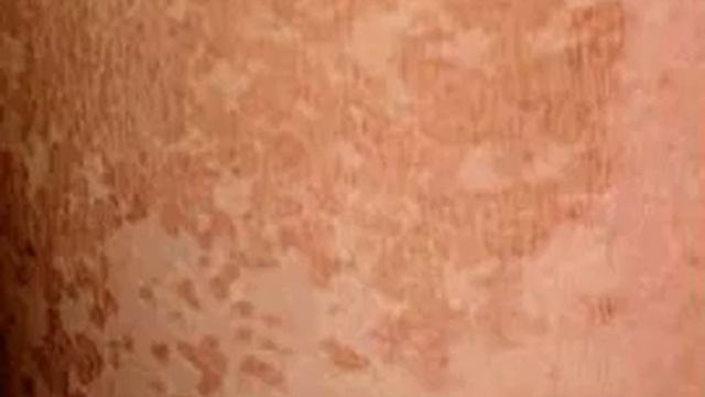 Разноцветный лишай смотреть онлайн