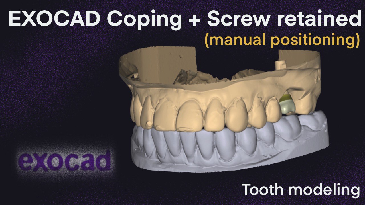 Coping + Screw Retained (manual Positioning) (Don`t Use Scan Body)