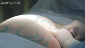 Лазерная липосакция: корректируем фигуру