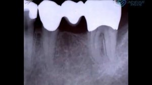 Зубной мост металлокерамика, установка, изготовление, цена.