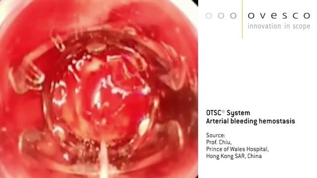 Остановка артериального кровотечения при помощи системы OTSC® смотреть онлайн
