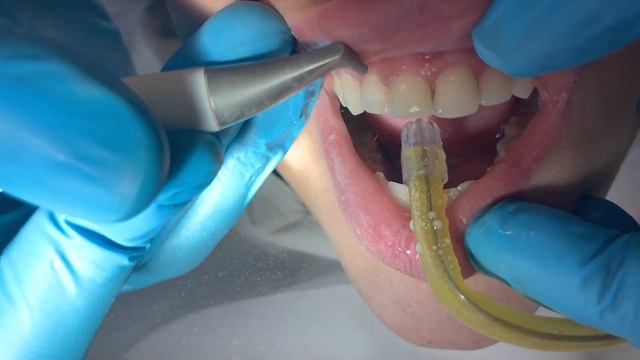 Dental Air polish смотреть онлайн
