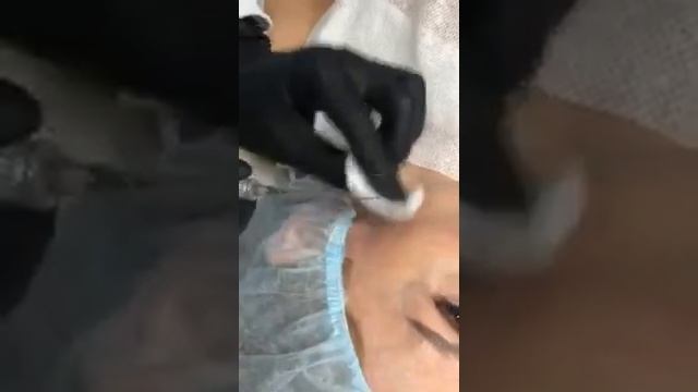 Полимолочная Кислота в шприце GANA PHV Коррекция ветви нижней челюсти и скуловой дуги смотреть онлайн