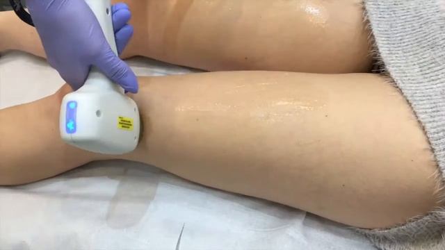 Promocja Na Depilację Laserową Soprano Ice Platinum Bydgoszcz