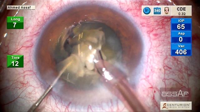 MiLOOP for N3 Cataract and Cornea Guttata. Ahmed Assaf смотреть онлайн