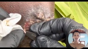 part 18  :  jigger feet removal ? ( please subscribe ) #nikolatesla