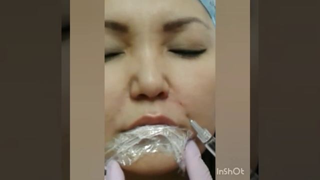 Коррекция носогубная складки филлером смотреть онлайн