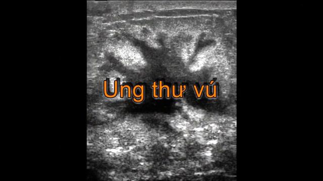Đau vú có thật sự nguy hiểm hay không? смотреть онлайн