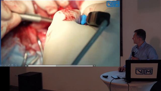 Хирургия селезенки. Как селезёнка влияет на асцит. Асцит можно контролировать. смотреть онлайн