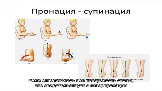 Что такое пронация стопы смотреть онлайн
