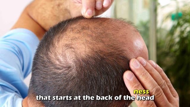 Propecia Vs Rogaine- Which Treatment Is Better? (Which Is Worth It?)