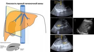 Плоскости сканирования печени.  Ультразвуковая анатомия печени
