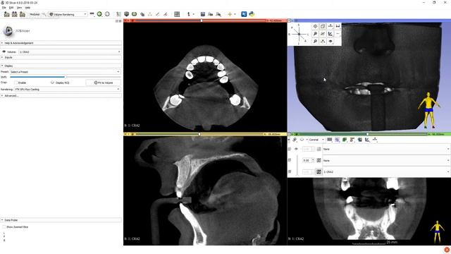 3D Slicer - просмотр КТ в стоматологии - Dr.Arut.ru смотреть онлайн