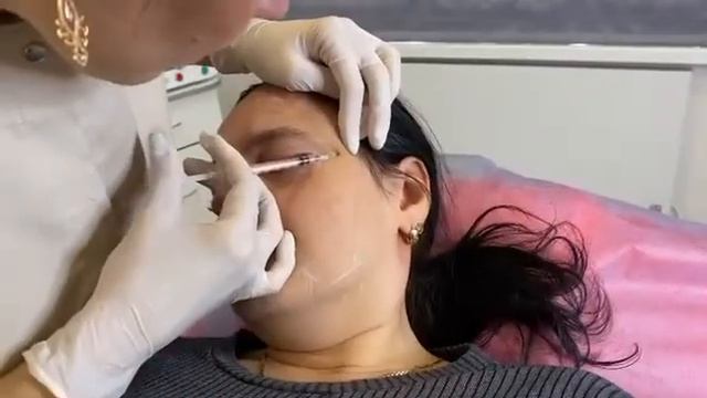✔️Ботулинотерапия Full Face смотреть онлайн
