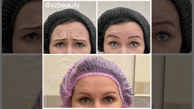 Результат инъекций ботулотоксина «Миотокс» в зону лба и межбровья смотреть онлайн