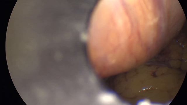 Мезентериальный тромбоз