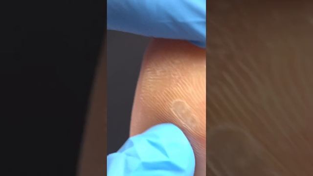 Remove foot corns safely #naileducation #pedicure #nails смотреть онлайн