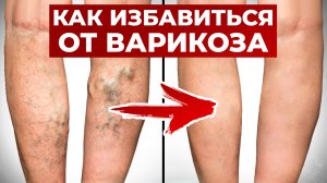 Как убрать варикоз БЕЗ ОПЕРАЦИИ? / НОГИ БОЛЬШЕ БОЛЕТЬ НЕ БУДУТ!