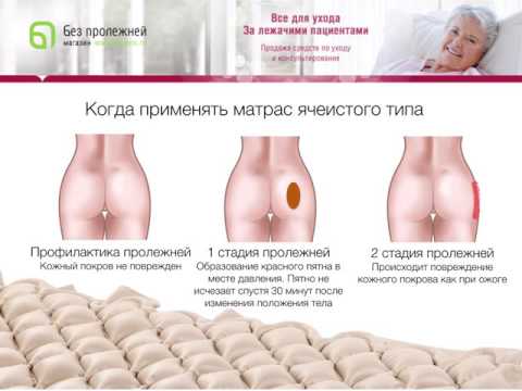 Как выбрать противопролежневый матрас? Обзор смотреть онлайн