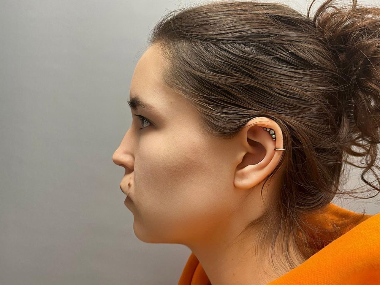 Блефаропластика в 20 лет, зачем молодые девушки это делают?